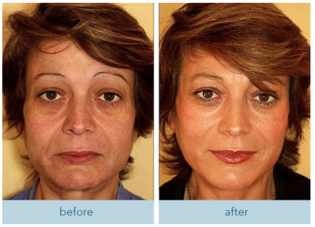 Before and after firming results