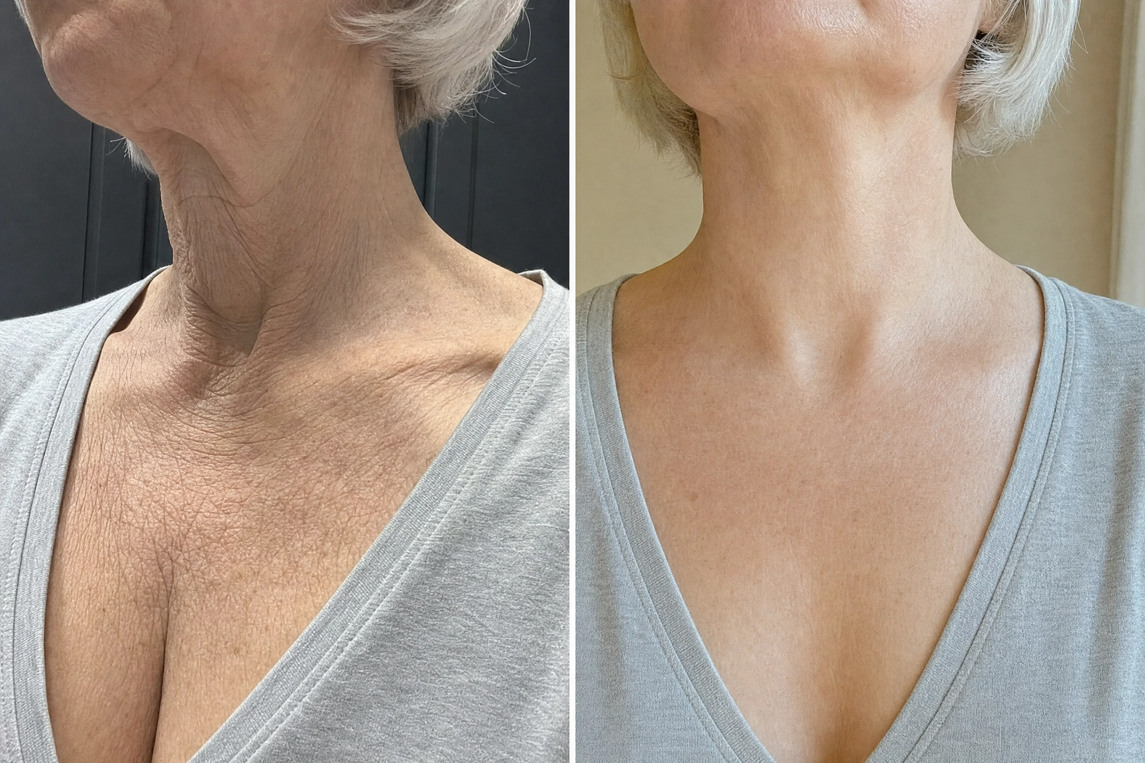 Neck and jawline before and after