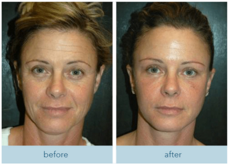 Reader results after using the routine